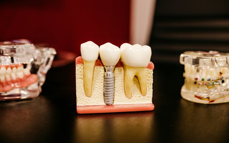 Modelo odontológico mostrando um implante entre dois dentes naturais