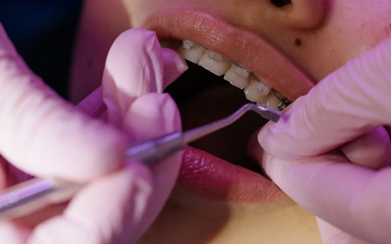 Exame de aparelho ortodôntico fixo com espelho odontológico